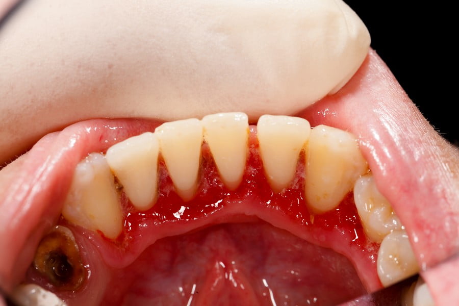 Lower incisors after periodontal treatment - broken tooth with
