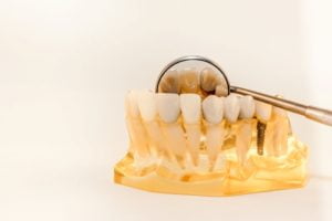 Questions to Ask a Dentist Before Getting Veneers