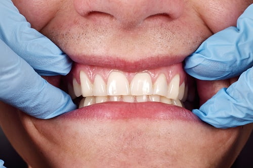 Surgeries to Treat Gum Recession