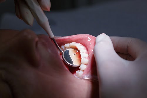 Surgeries to Treat Gum Recession