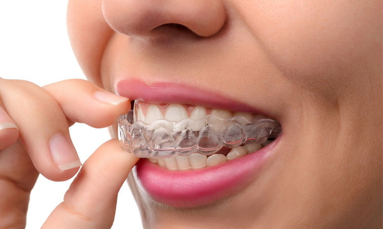 Woman-wearing-a-orthodontic-silicone-trainer-opt