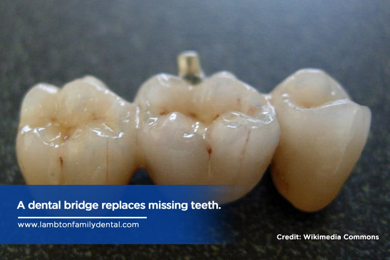 A dental bridge replaces missing teeth.