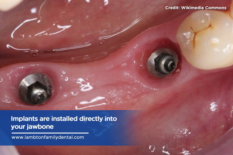 Implants are installed directly into your jawbone