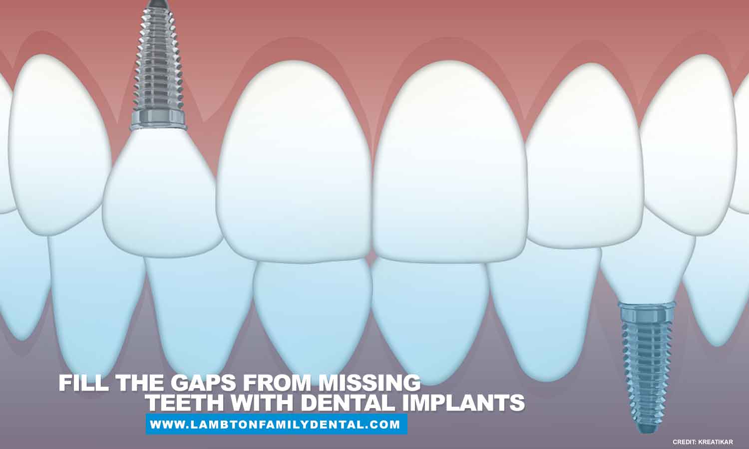 Fill the gaps from missing teeth