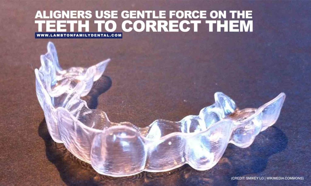 Everything You Need to Know About Invisalign | Lambton Family Dental
