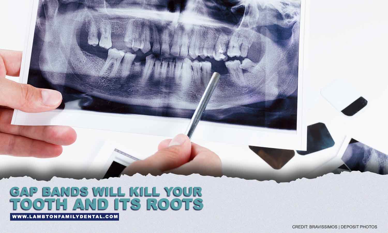 The Dangers of DIY Braces Lambton Family Dental