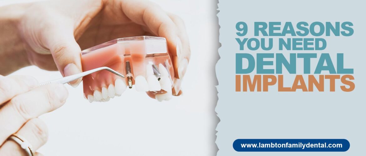 9 Reasons You Need Dental Implants