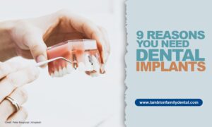 9 Reasons You Need Dental Implants