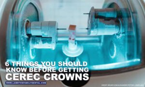 6-Things-You-Should-Know-Before-Getting-CEREC-Crowns-opt
