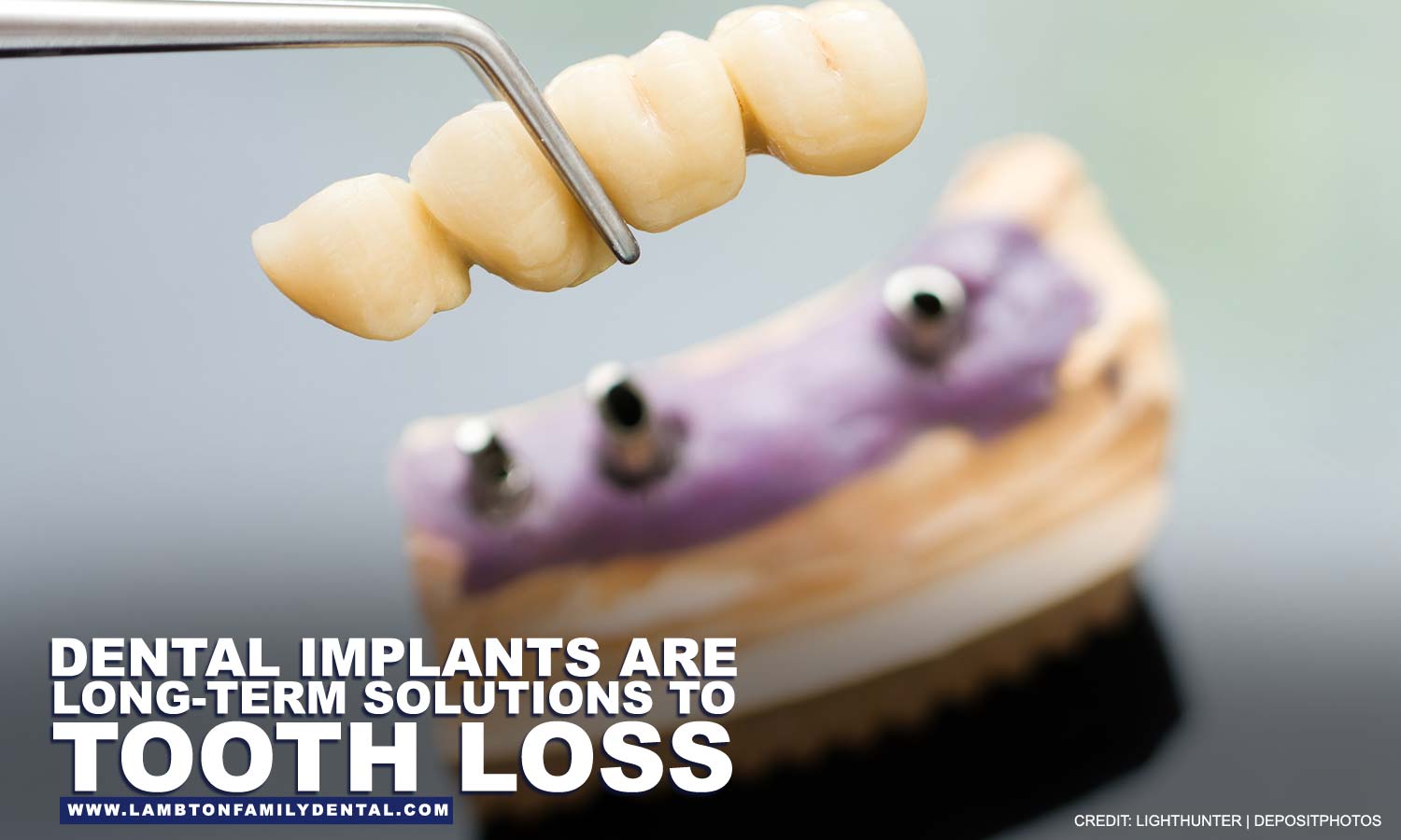 Dental implants are long-term