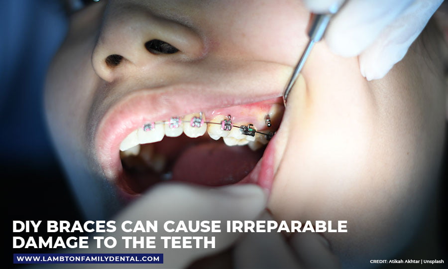 DIY braces can cause irreparable damage to the teeth