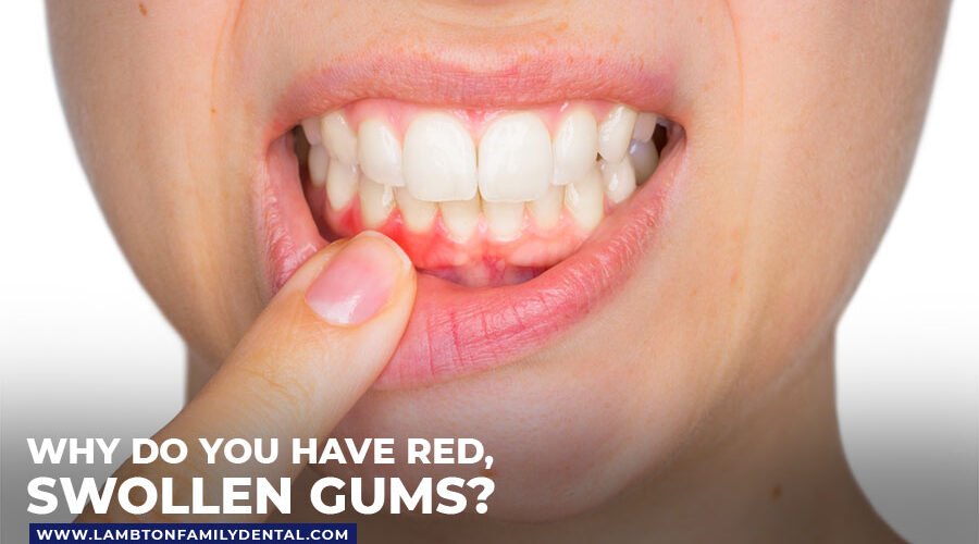 Why Do You Have Red, Swollen Gums?