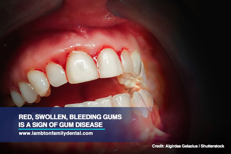 Red, swollen, bleeding gums is a sign of gum disease