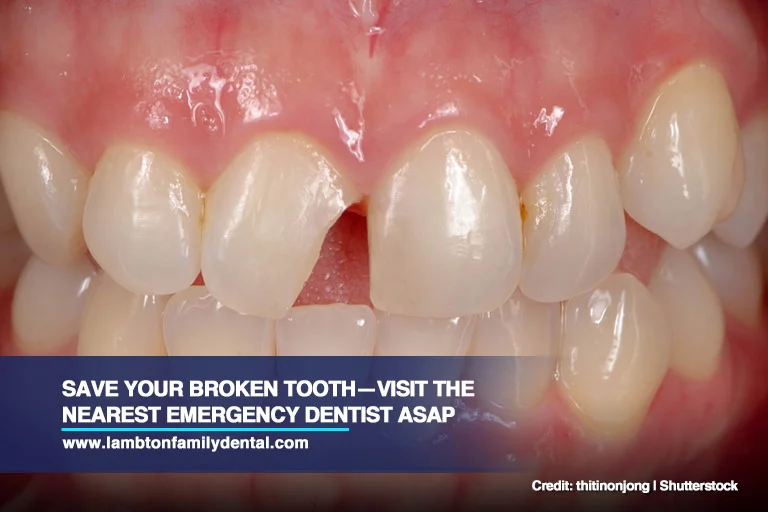 Save your broken tooth—visit the nearest emergency dentist ASAP