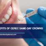 7 Benefits of CEREC Same-Day Crowns