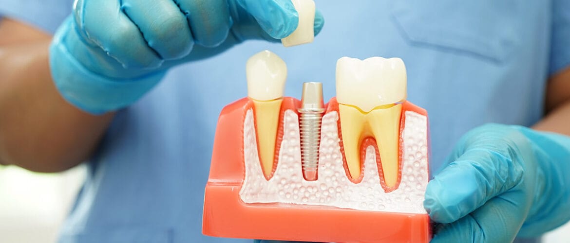 Your-2025-Guide-to-Minimally-Invasive-Dental-Implants