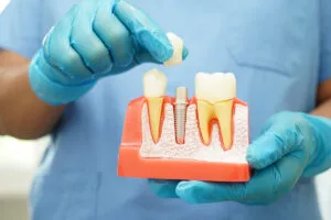 Your-2025-Guide-to-Minimally-Invasive-Dental-Implants