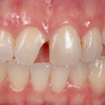 How-to-Prevent-Dental-Emergencies-While-Playing-Sports-1