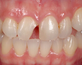 How-to-Prevent-Dental-Emergencies-While-Playing-Sports-1