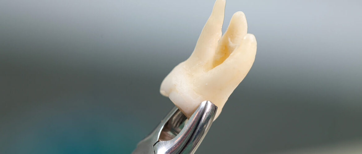 9-Signs-It’s-Finally-Time-for-Wisdom-Tooth-Extraction