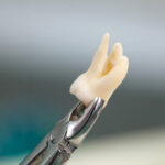 9-Signs-It’s-Finally-Time-for-Wisdom-Tooth-Extraction