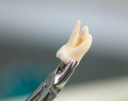 9-Signs-It’s-Finally-Time-for-Wisdom-Tooth-Extraction