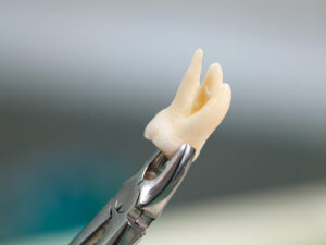 9-Signs-It’s-Finally-Time-for-Wisdom-Tooth-Extraction