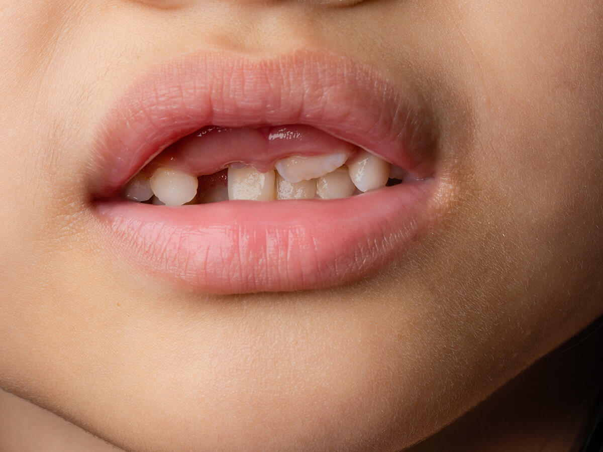 How-Thumbsucking-Affects-Dental-Health
