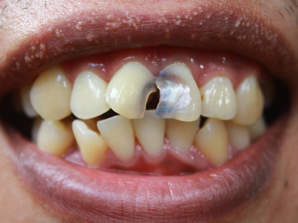 Tooth-Shades-and-What-They-Reveal-About-Your-Health