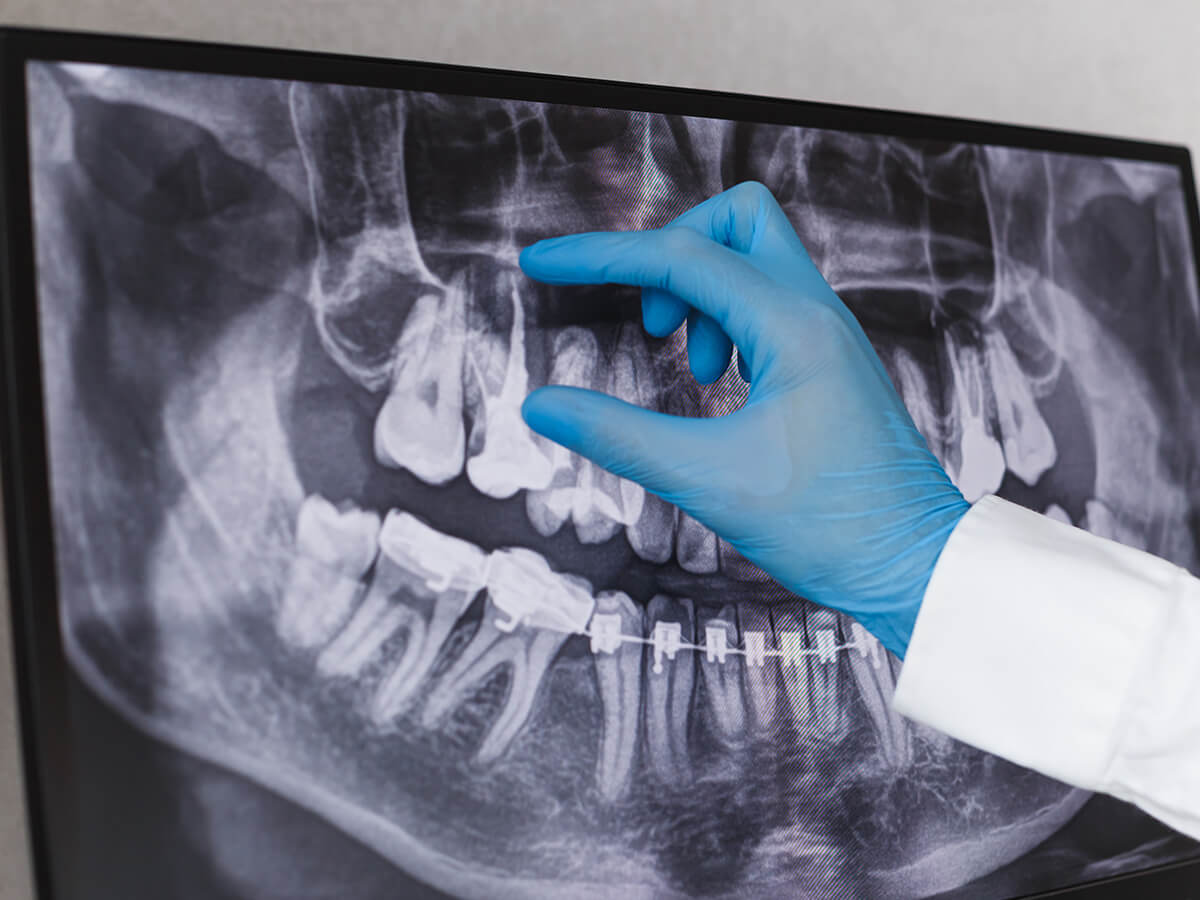 How-Do-Soft-Tissue-and-Gum-Symptoms-Indicate-Wisdom-Tooth-Complications