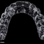 What-Should-You-Ask-Before-Committing-to-Invisalign